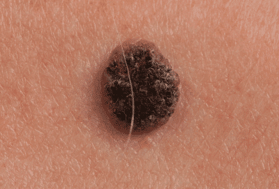 Closeup of a dark suspicious-colored mole, representing the different types of skin cancer