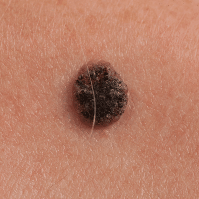 Closeup of a dark suspicious-colored mole, representing the different types of skin cancer